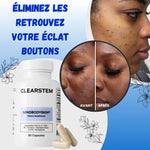 Load image into Gallery viewer, Complément hormonal contre l'acné
